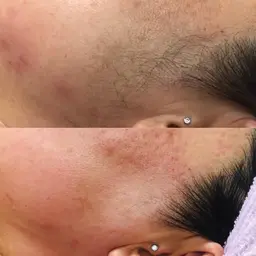 フェイシャル脱毛　お顔の産毛をシュガーリングでスッキリ✨パック付き✨光脱毛でなくなりづらい黒くない毛にも反応します