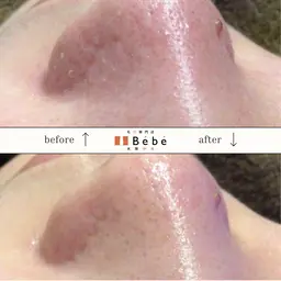 おかえりクーポン【再来】前回のご予約から3週間以内のご予約の場合、割引あり！吸引+お悩みに合わせた美容液