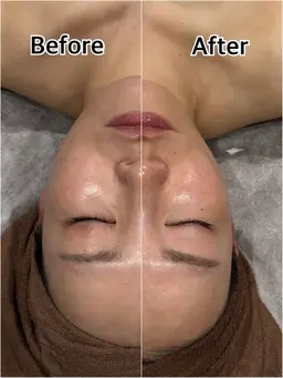 【小顔も透明感も】炭酸ガスケア込リフトアップフェイシャル＋美容成分導入