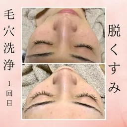 【毛穴洗浄】毛穴に悩んでいませんか?