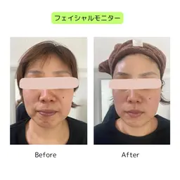 植物性ミネラルで整える小顔フェイシャル:モニター(お写真、アンケートのご協力をお願いいただける方限定)