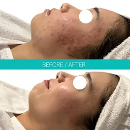 【徹底ニキビケア✨】結果を出したい方へ！フォトRF肌質改善・ニキビ・跡解消　¥3,980