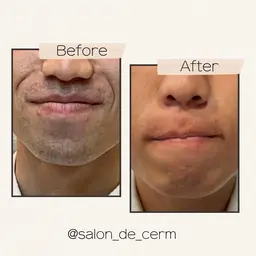 初回【期間限定】全身脱毛特別価格✨