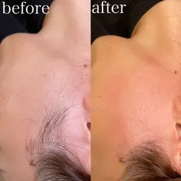 WAXパーツ脱毛🫶もみあげ