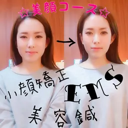 【美顔コース】▷美顔鍼50本▷パルス美顔鍼▷美顔矯正(小顔矯正+頭蓋骨矯正)▷エレクトロ小顔調整▷炭酸ミスト