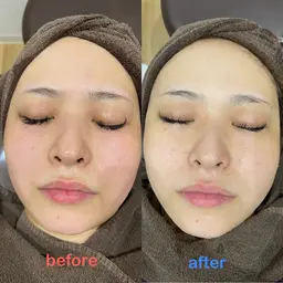 【初回体験】ツルもちお肌✨ハイドラフェイシャル&エレクトロポレーション