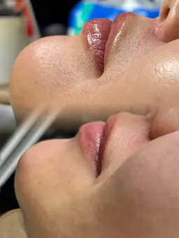 【美肌】フェイシャルワックス(眉周り除く)【クレンジング・パック付】¥8000→¥6000