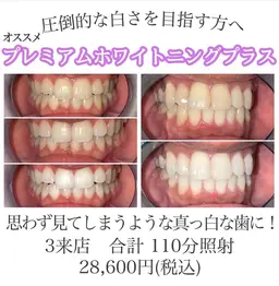 【超お得】プレミアムホワイトニングプラス 3来店計110分照射 短期集中ホワイトニングケアに🦷✨