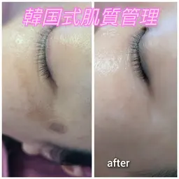 悩んでる方おすすめ✨肌頑固なシミ❗肝斑❗改善◇高濃度美容液◇お肌の深部に導入❗