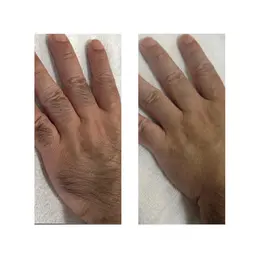 💎脱毛 手の甲・指のみ