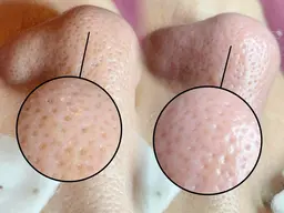 《ピーリング付き》毛穴エクストラクション（鼻のみ）➕1,000円で１パーツ追加🆗