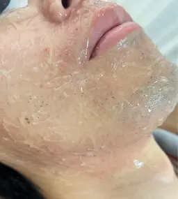 【メンズ】顔脱毛