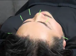 【眼精疲労解消鍼】👀たった4本で目元スッキリ!✨最新・眼精疲労ケア美容鍼✨