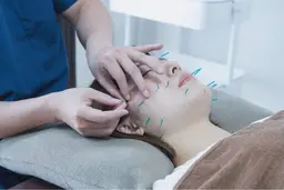【小顔になれる！】美容鍼