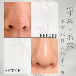 モニター価格📷【期間限定】≪鼻のみ👃≫毛穴洗浄(ハイドラ👃)+💎温感スキンインフュージョン🚹男性も◎