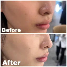 毛穴ケアコース