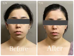 通常価格【マリオネット】筋膜リリース×美顔器=小顔・造顔★60min【¥13200→¥6600】