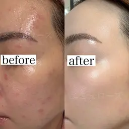 【インセルダム】韓国艶肌体験2,200円　話題のスキンケアを徹底的にサポート♪男性の方もご予約いただいています！