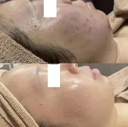 14日限定🌸新生活に🌸【フェイシャル×顔脱毛】全顔IPL照射で美肌×毛穴レス🩵今だけピーリングと美容液導入付💫