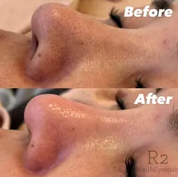 【フェイシャル】毛穴ハイドロピーリング(顔全体コース)¥4500