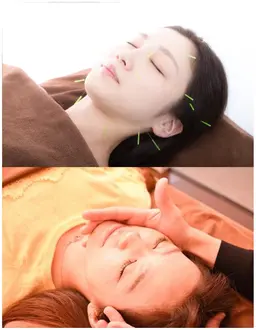 🔹ミニモ限定🔹電気付き美容鍼＋小顔矯正＋首、肩リンパマッサージ👑