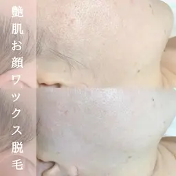 【ツヤ肌フェイシャルワックス（全顔）（顔脱毛）】つるつるアフターハイドロパック付き🥚