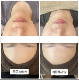 ハーブピーリング【毛穴、ニキビ】