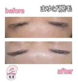 💆🏻‍♀️アイブロウ脱毛✨デザイン相談させてください‼︎眉周りの毛をなくしたい方‼︎まゆげサロンいらずに👍🏻