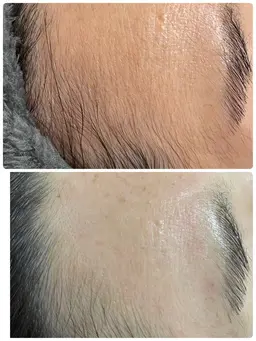 シュガーリング 顔