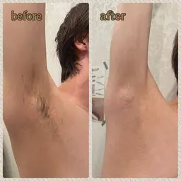 🌟両脇脱毛🌟一回で抜けた！減った！が実感できる脱毛