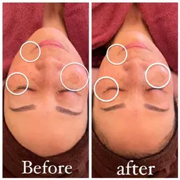 陶肌トリートメント　　ハーブピーリング