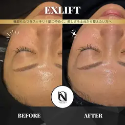 【✨小顔×艶肌ケア】EX LIFT｜むくみ・たるみ・透明感まで同時アプローチ〈メンズOK〉