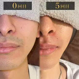 【プロ施術】清潔感を整える顔脱毛 脱毛範囲>口周り/頬/アゴ裏/もみあげ/デコ/鼻