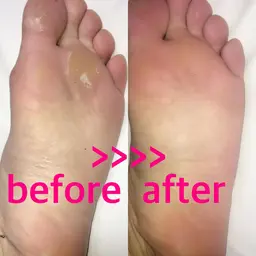 フット角質ケア