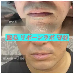 6/28までのご予約限定【メンズ🧔オーダーメイド髭脱毛】最速で人生変えちゃう⁉︎😎爆抜け脱毛体験