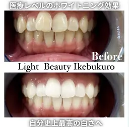 もっと激白ホワイトニング‼️圧倒的な白さ✨✨Wホワイトニング✨✨《合計110分照射3来店コース》✨🦷✨