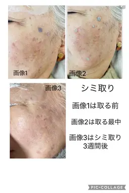 ホクロやシミ抜き