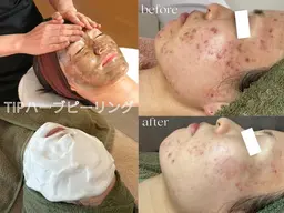 【3・4月限定】TIPハーブピーリング♪陶器肌¥14,000円→¥8,00円ミニモ限定