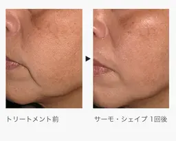 お試し【夏までに顔痩せ】1回で変わる顔痩せコース🫧