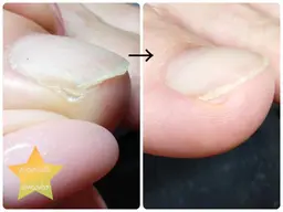 軽度の巻爪カット