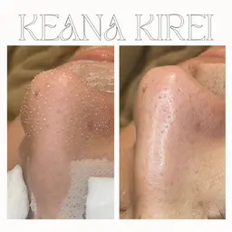 ✨韓国式3D毛穴洗浄✨小鼻/頬/アゴ/眉間…いちご鼻の黒ずみをしっかり取り除きます！