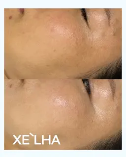 ミニモ限定💎 セラピール（2025年ピーリング部門韓国No.1｜剥離なしで毛穴・くすみ・ニキビに効果的次世代ピーリング