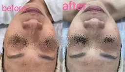 【人気No.2】一回で絶対美白★毛穴洗浄付き白玉肌コース¥12,660→新規¥10,560