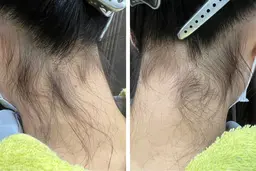 リピート率No.1👑【うなじ脱毛】お得な\3回分/¥3960/シェービング込み♦︎