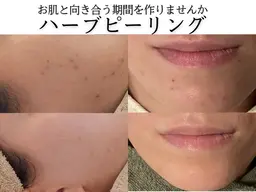 【剥離あり】ハーブピーリング