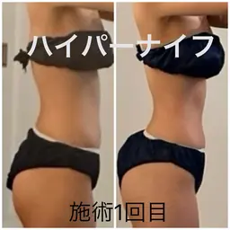 【痩身人気No.1】ハイパーナイフ全身 リンパマッサージ付き150分