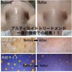 頑固な黒ずみ撃退‼️徹底毛穴洗浄毛穴レスアルティメイトコース🌟黒ずみ　ニキビ　ニキビ跡　毛穴縮小⭕️全顔水素吸引付‼️