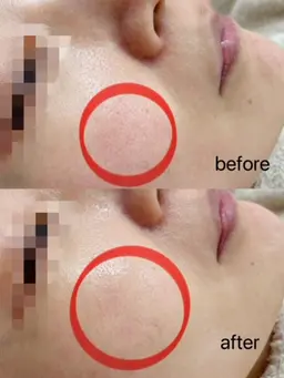 【毛穴×ニキビケア】5step!肌のキメと美白♪全顔毛穴洗浄吸引+全顔酵素ピール+毛穴引き締めエッセンス¥5500