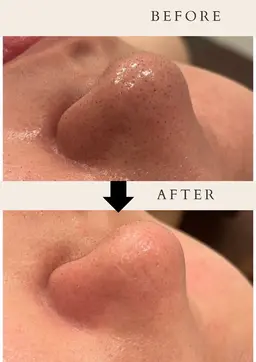 【ミニモ学割🏫】❣️美容液毛穴洗浄✨