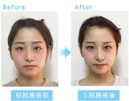 人気No.1💙本場韓国式 小顔コルギ 即実感◎ 90分